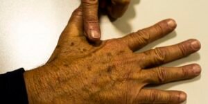 Desinformação sobre câncer de pele afeta diagnóstico, diz instituição